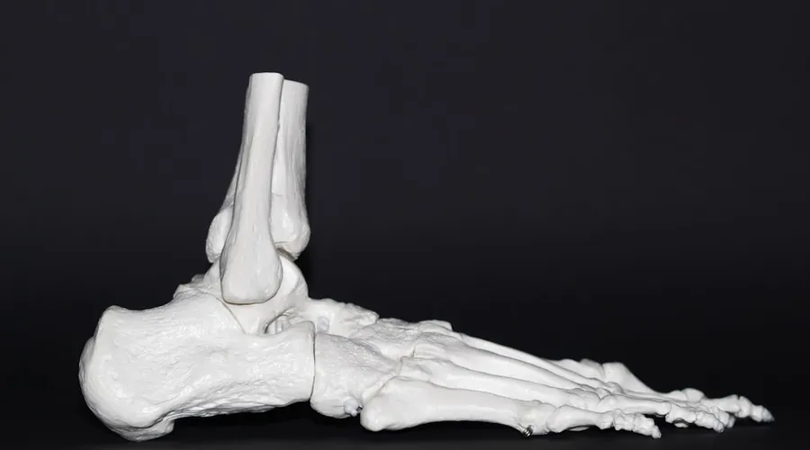 arthrose