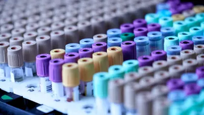 Alzheimer per Bluttest: Ab Juli Ergebnis in 17 Minuten